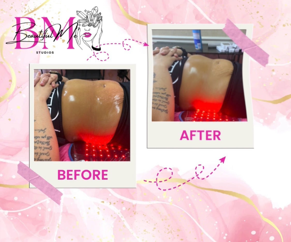 Fat Sculpting Treatment Stomach