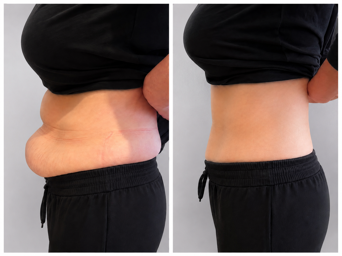 Fat Sculpting Treatment Stomach