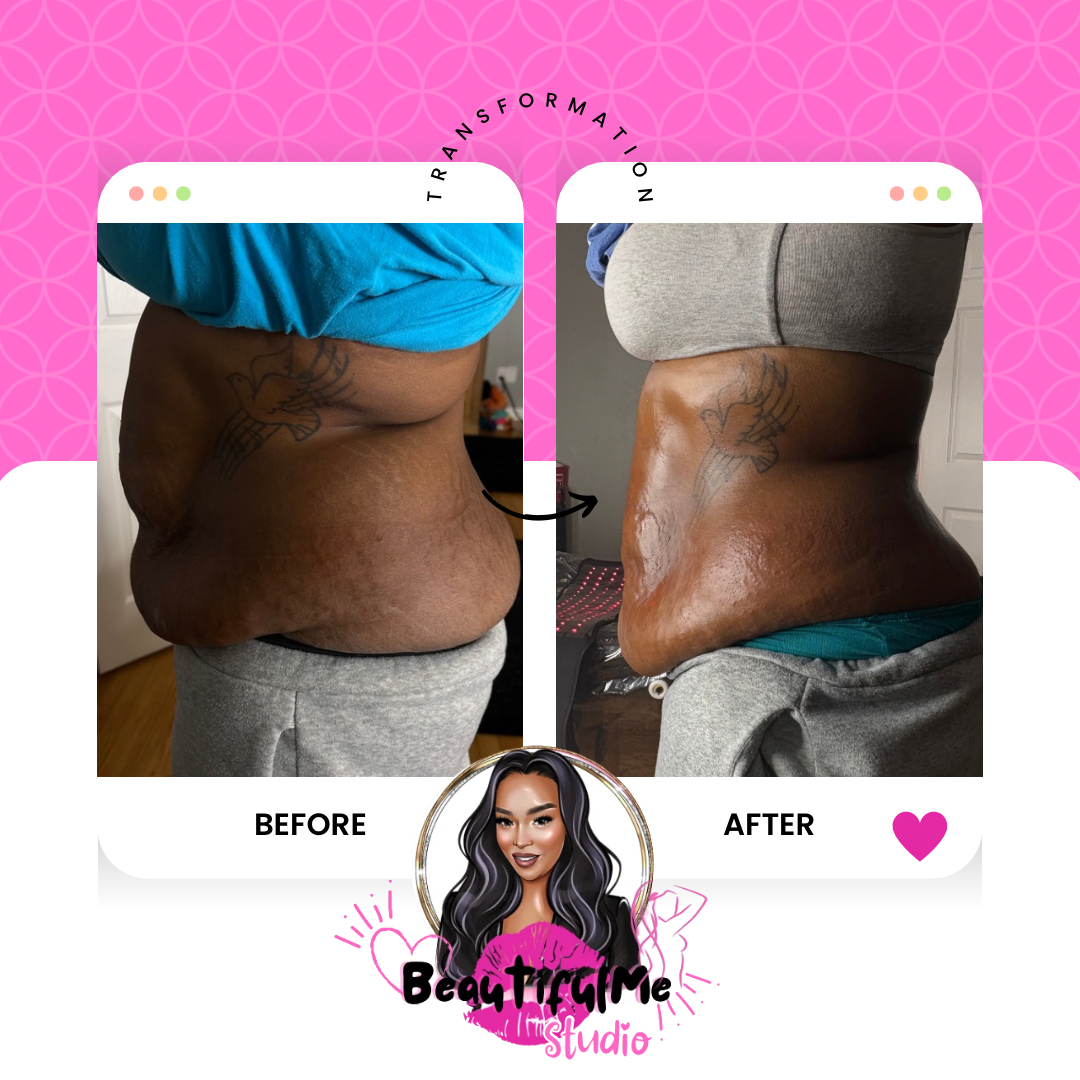 Fat Sculpting Treatment Stomach