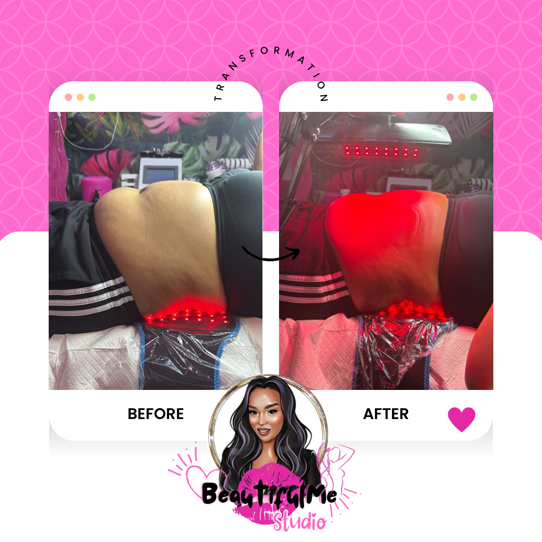 Fat Sculpting Treatment Stomach