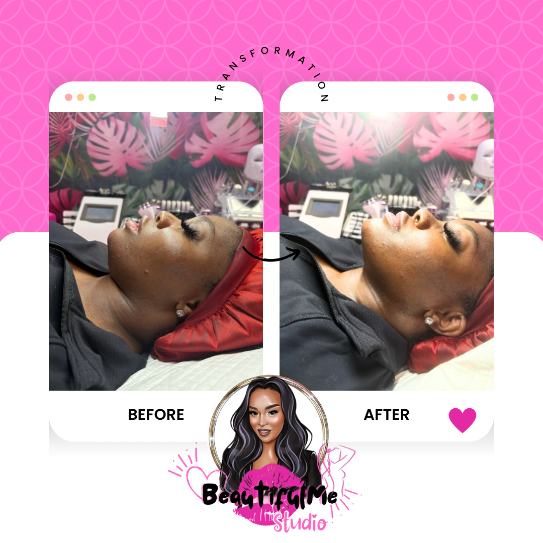 Face Non Invasive Chin Sculpting