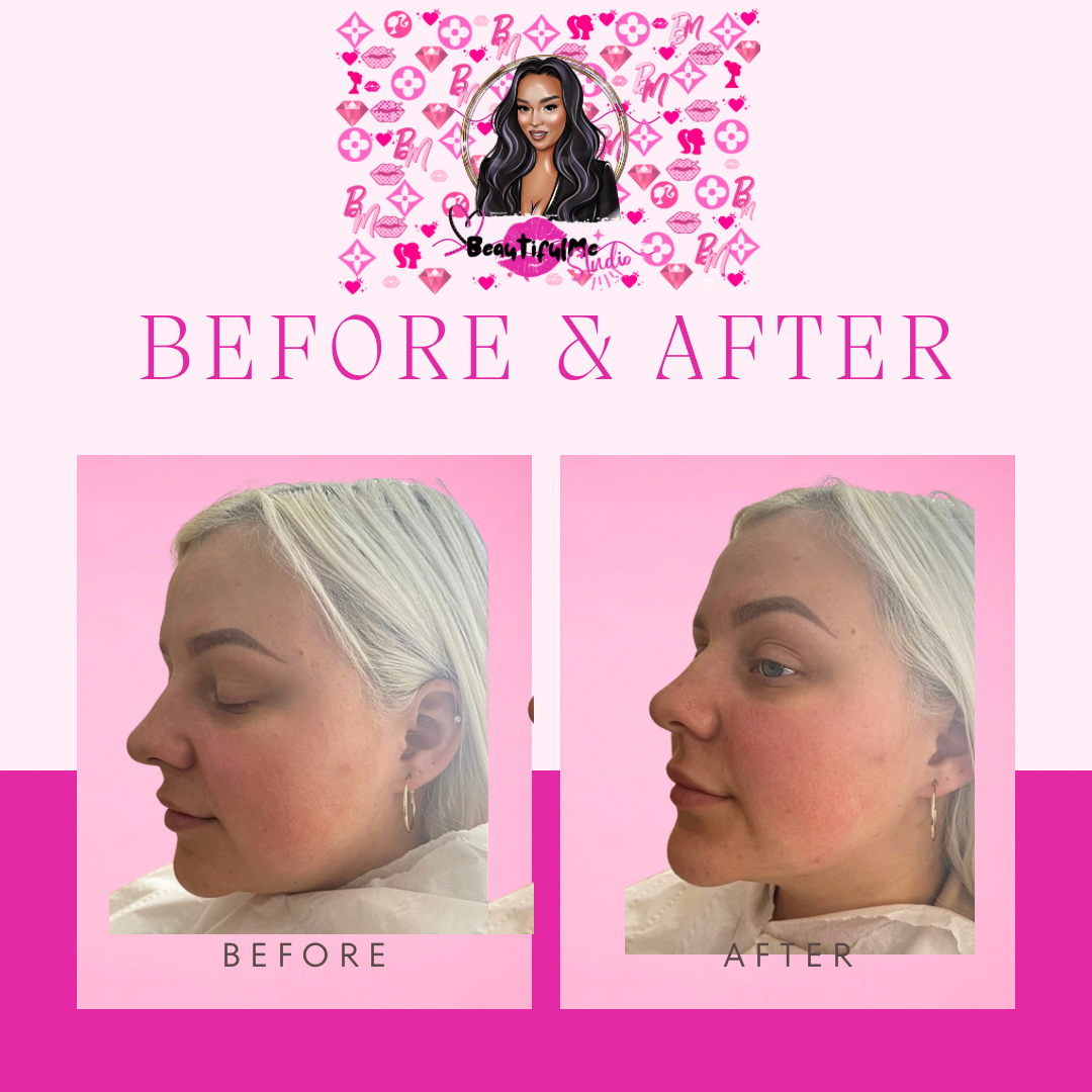 Face Non Invasive Chin Sculpting